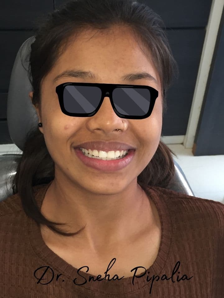 After braces treatment with Dr. Sneha Pipalia, Rajkot