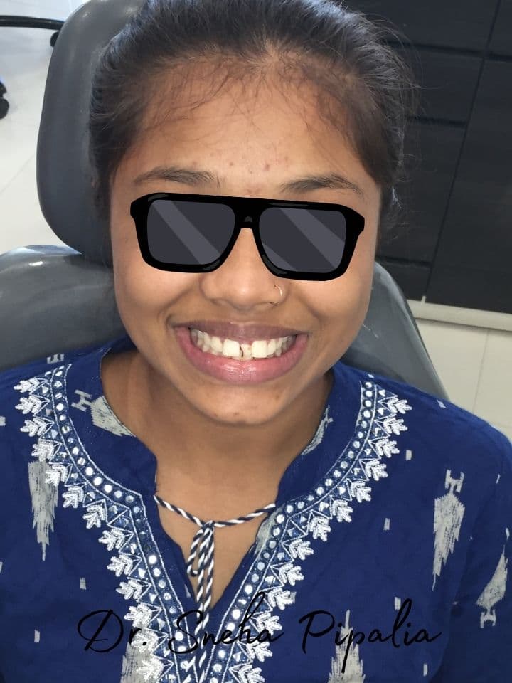 Before braces treatment — Nirali H, Rajkot